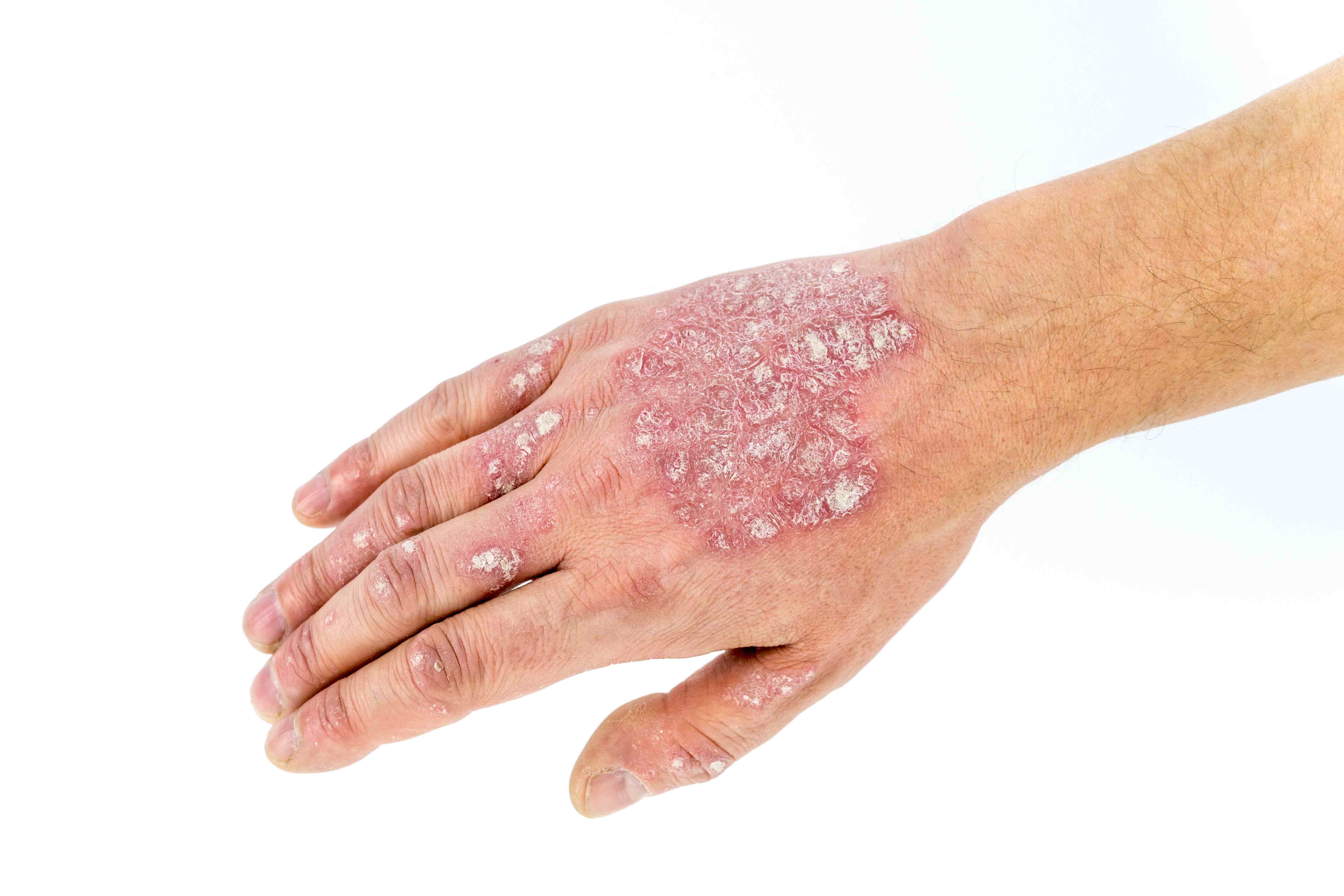 Psoriasis 